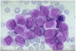 慢粒白血病吃哈密瓜好吗,哈密瓜对慢粒白血病患者的影响探讨